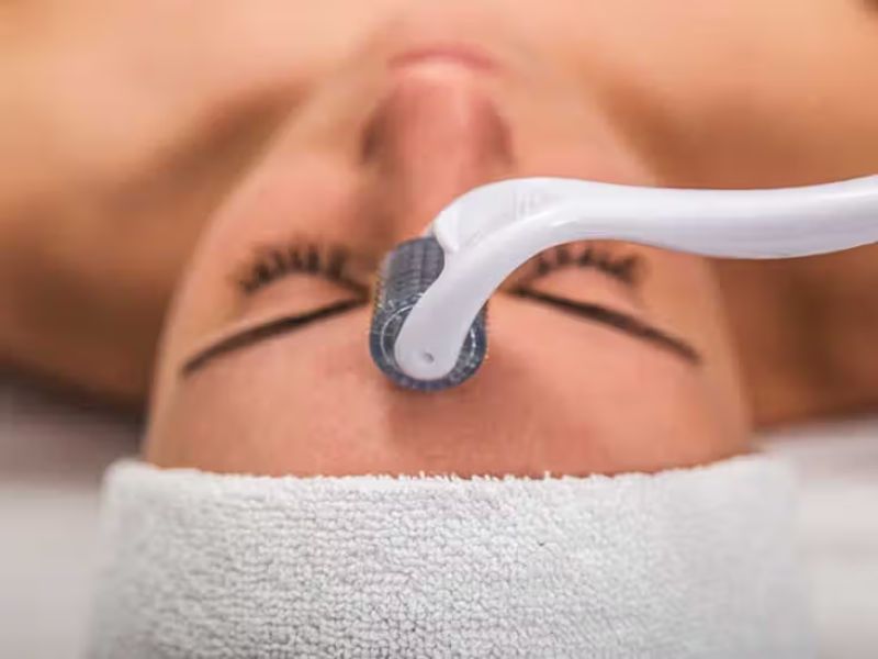 Why Fitness Enthusiasts Are Turning to Microneedling for Skin Health